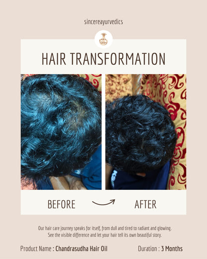 Ayurvedic Hair Oil for Permanent Hair Loss 200 ML | Chemical-Free & Natural