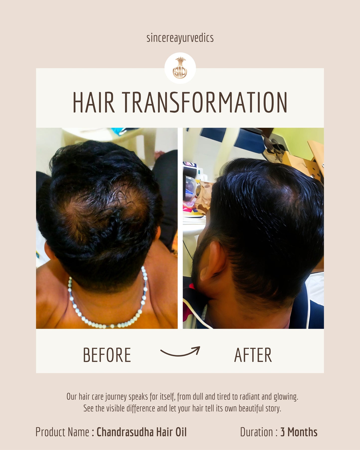 Ayurvedic Hair Oil for Permanent Hair Loss 200 ML | Chemical-Free & Natural