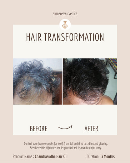 Ayurvedic Hair Oil for Permanent Hair Loss 200 ML | Chemical-Free & Natural