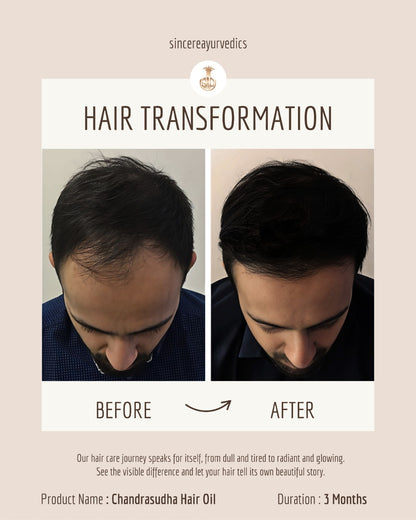 Ayurvedic Hair Oil for Permanent Hair Loss 200 ML | Chemical-Free & Natural