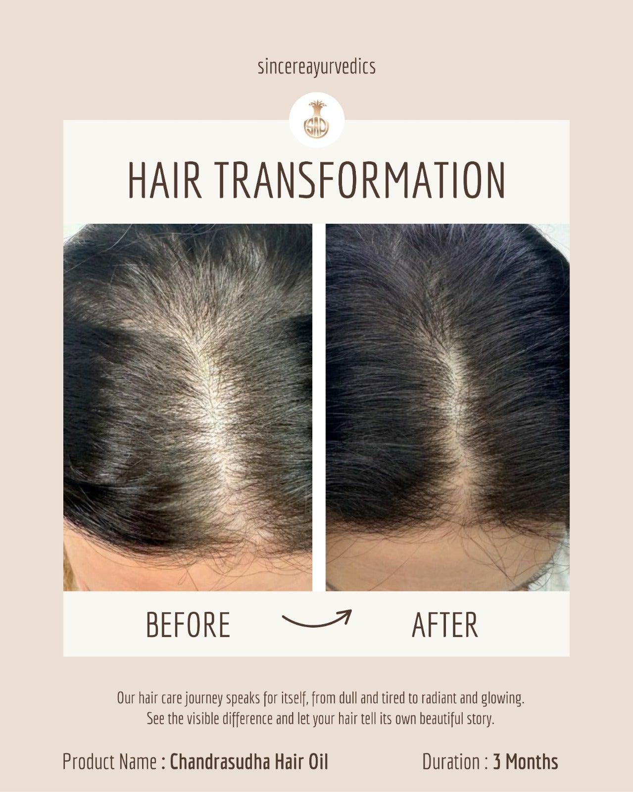 Ayurvedic Hair Oil for Permanent Hair Loss 200 ML | Chemical-Free & Natural